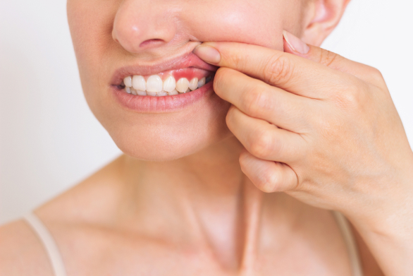 Girl lifting up her lip to show swollen gums